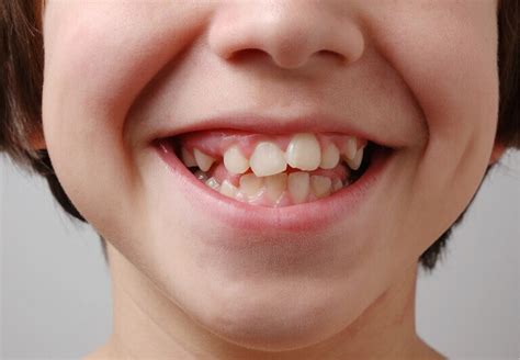 Sneda Tänder And Tandställning För Barnvuxen Typer And Pris