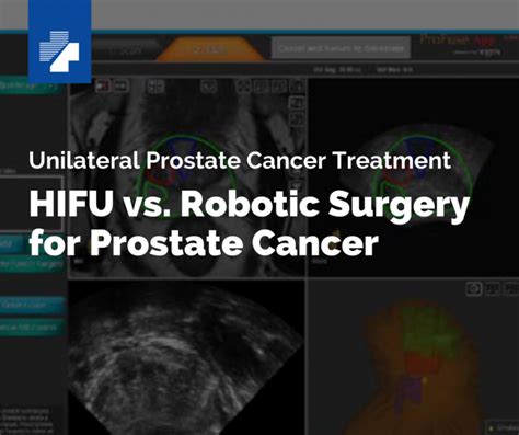 Comparing HIFU And Prostatectomy Prostate Cancer Treatment HIFU Prostate Services