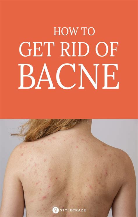 How To Get Rid Of Bacne For Good Bacne Natural Hair Mask Beauty Hacks