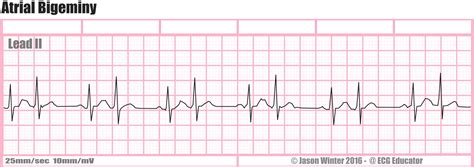 Ecg Educator Blog Atrial Bigeminy