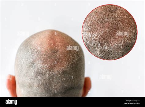 Man Scratch Head Bald Hi Res Stock Photography And Images Alamy