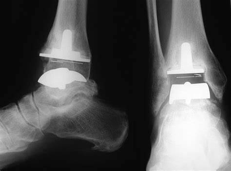 Артроз голеностопного сустава диета Артроз Голеностопного Сустава Фото Лечение — Mixyfotos.ru Артроз Голеностопного Сустава Фото Лечение — Mixyfotos.ru Артроз голеностопного сустава диета