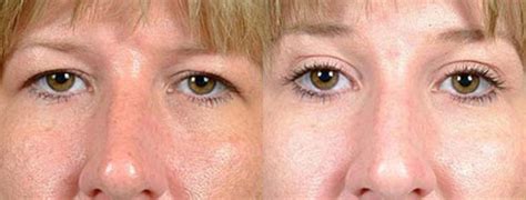 Eyelid Surgery Before And After Photos Patient 76 Louisville Ky