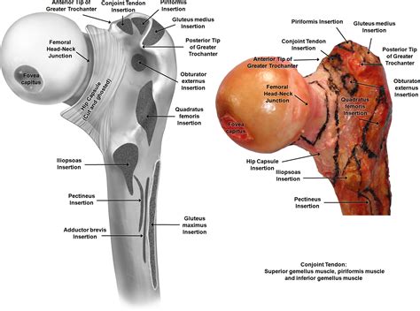 Surgically Relevant Bony And Soft Tissue Anatomy Of The Proximal Femur