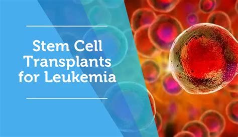 Stem Cell Transplants For Leukemia Myleukemiateam