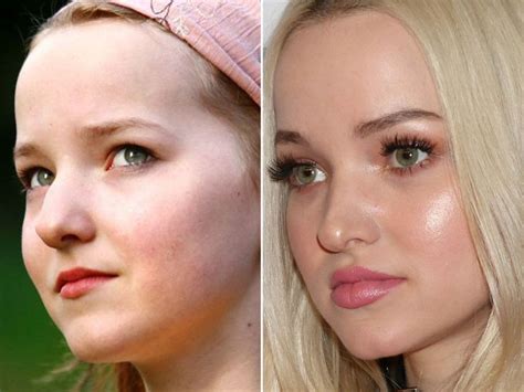 Dove Cameron Before And After Dove Cameron Lips Dove Cameron