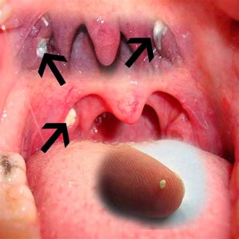 Check spelling or type a new query. Tonsil Stones Removal - Learn on How to Remove Your Tonsil ...