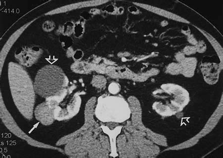 Renal computed tomography (ct) shows a left clear cell renal cell carcinoma (crcc) with left perinephric extension. False-negative finding of perinephric spread of renal cell ...