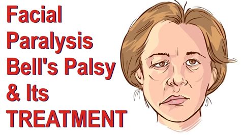 Bell S Palsy Cause Symptom Physiotherapy Treatment Exercise