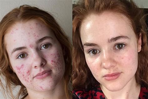 Review Accutane For Acne Usage Side Effects Before After Picture