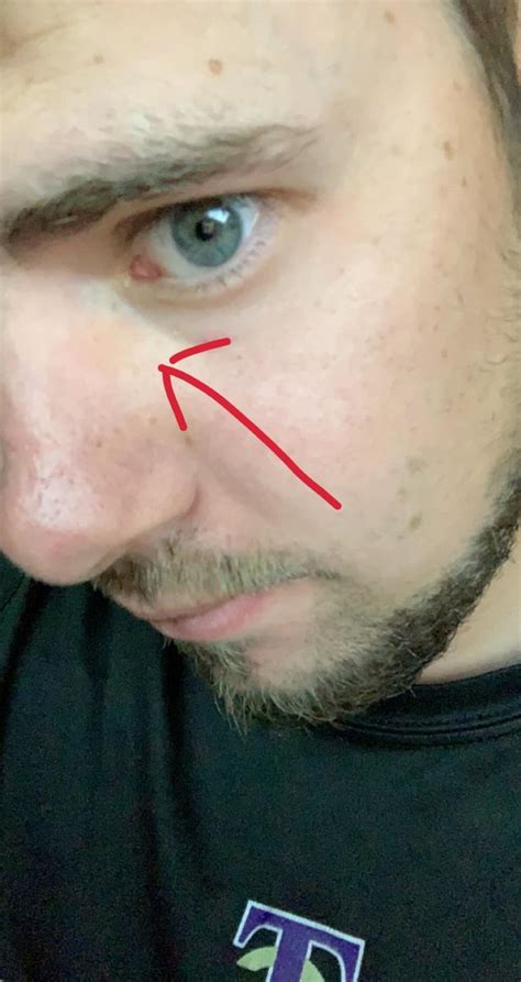 Yellow Spot On Side Of Nose Under Eye What Could It Be Not Other