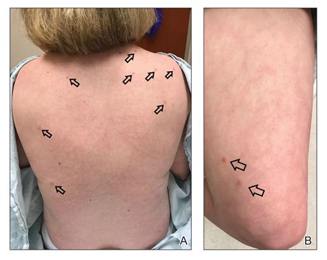 Multiple Eruptive Dermatofibromas Associated With Down Syndrome