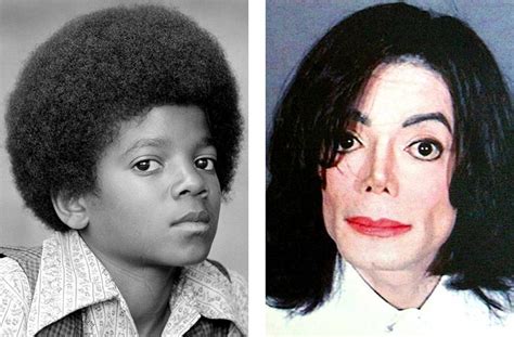 Key Facts Michael Jacksons Vitiligo Skin Disease Condition Oprah