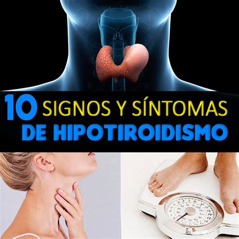 Signos Y S Ntomas Del Hipotiroidismo La Gu A De Las Vitaminas