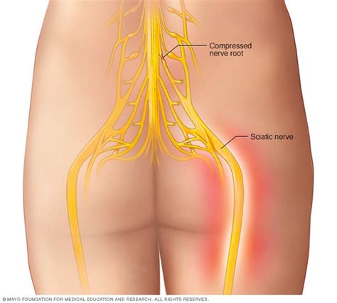 Sciatica Symptoms And Causes Mayo Clinic