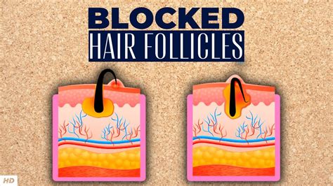 Blocked Hair Follicle Everything You Need To Know Youtube