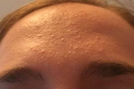 Tiny Colorless Small Bumps All Over The Forehead General Acne