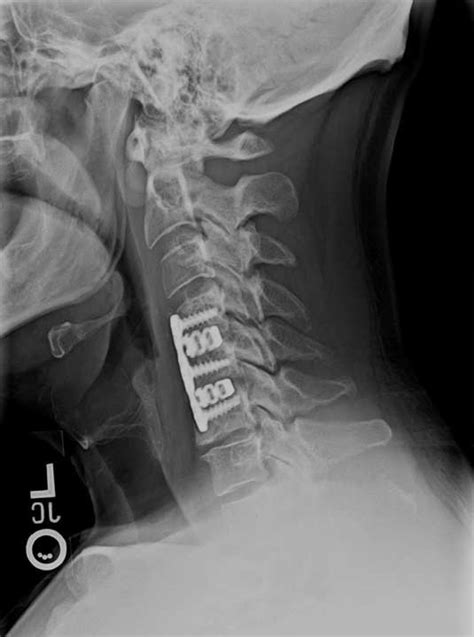 Cureus A Novel 3d Printed Titanium Implant For Anterior Cervical