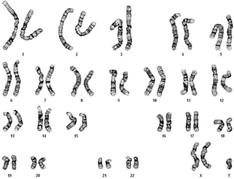 A Karyotype Of 47xxy Download Scientific Diagram