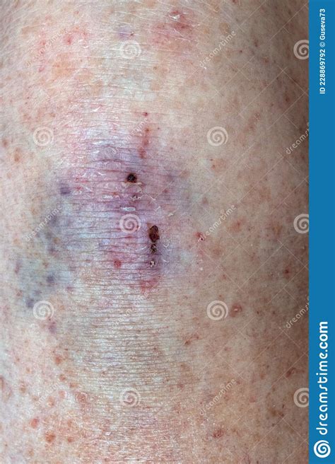 Large Bruise Hematoma On The Humans Leg On The Skin In Different Colors