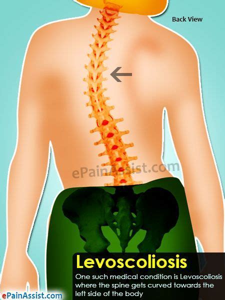 Levoscoliosis Scoliosis Scoliosis Exercises Physical Therapy