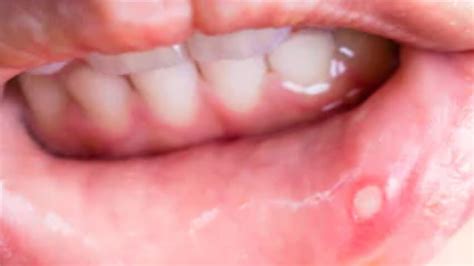 How To Get Rid Of Canker Sores On Roof Of Mouth Youtube