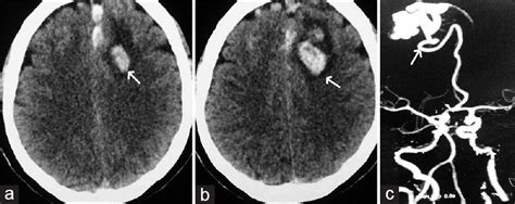 Intracranial Pial Arteriovenous Fistulae Diagnosis And Treatment