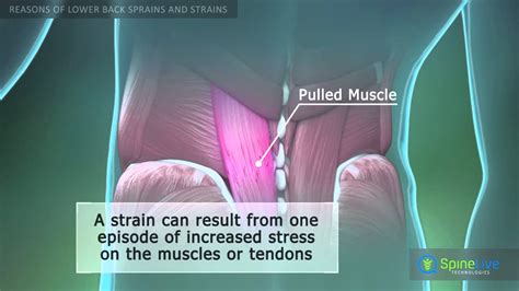 Lower Back Sprains And Strains Reasons Youtube
