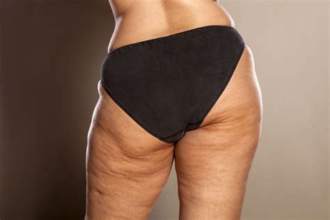 The Difference Between Stretch Marks And Cellulite