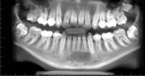 Diagnosis For Bc Oral Pathology Case 40 The Empty Lesion Dentistryiq