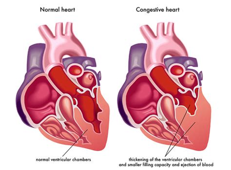 Congestive Heart Failure Symptoms And Treatments The Heart Foundation