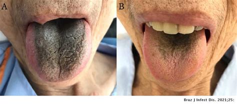 Black Hairy Tongue Caused By Metronidazole The Brazilian Journal Of