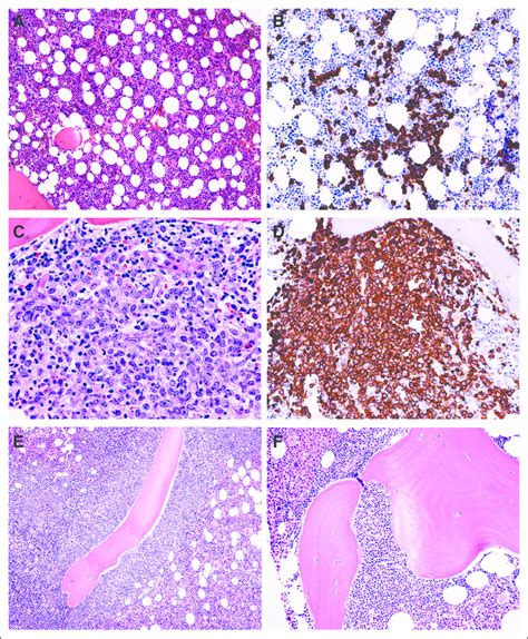 Lymphoma Involvement In Staging Bone Marrow Biopsies For Diffuse Large