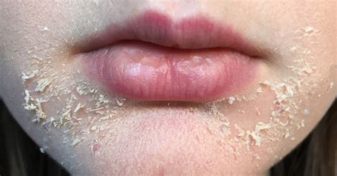Dry Flaky Skin Around Mouth And Lips