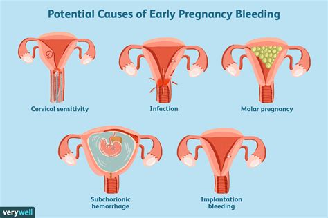 Does Early Pregnancy Bleeding Mean A Miscarriage
