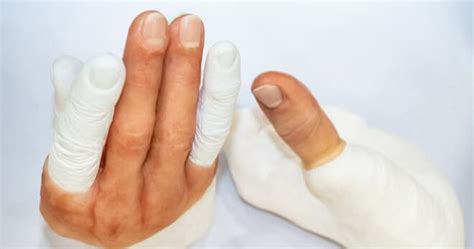 Prosthetic Solutions For Finger Amputations A Comprehensive Guide