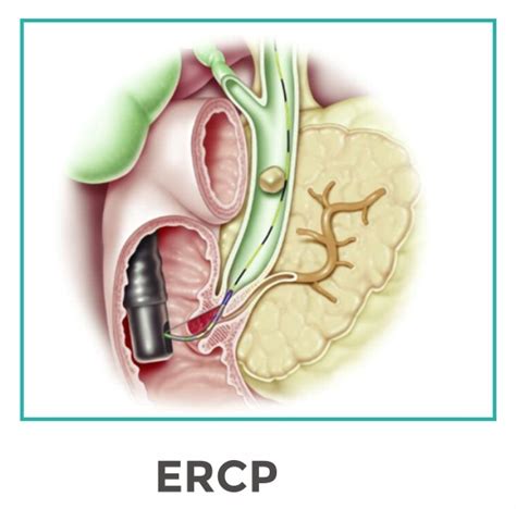 Ercp Endoscopic Retrograde Cholangio Pancreatography