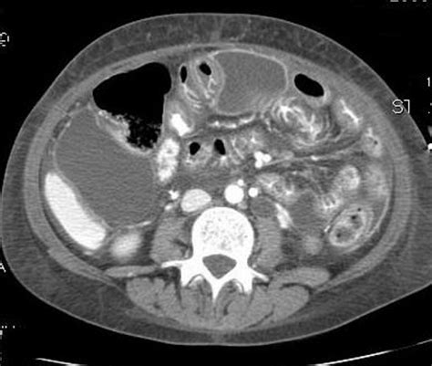 Ct Abdomen Showing Multiple Loculated Fluid Collections In The Sub
