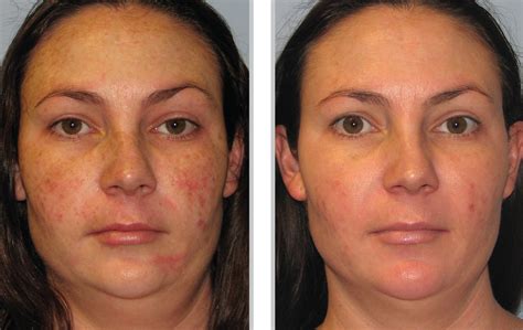 Ipl Before And After Photos Phototherapy Bblipl Photos