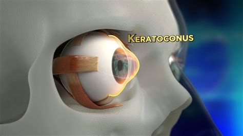 Keratoconus Procedure Explained Youtube