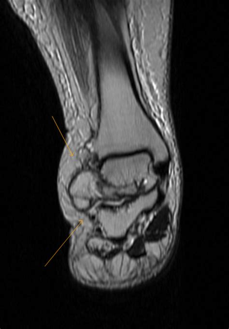 Lipoma Arborescens Of Ankle Rare Case Sumers Radiology Blog
