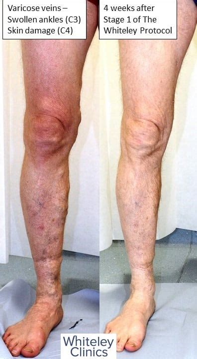 Huge Varicose Veins Treated With Endovenous Surgery The Whiteley Clinic