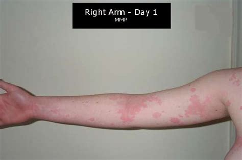 Right Arm Day 1 Joints Are Always A Hotspot For Hives Y Flickr
