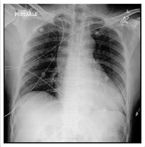 Anteroposterior Ap View Of Portable Chest Radiograph Showed A