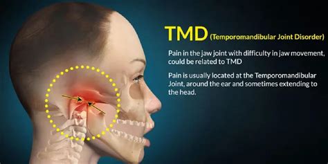 Jaw Pain Tmd Neocare