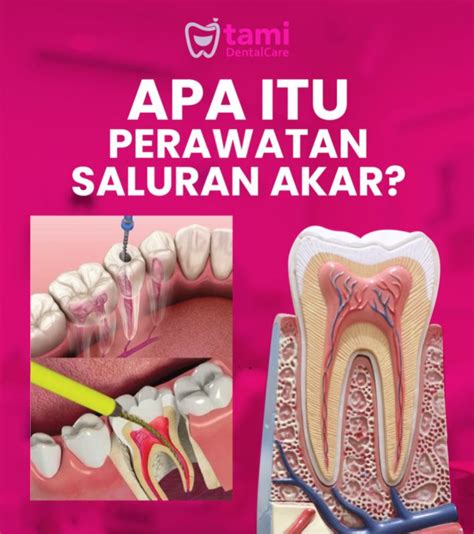 Apa Itu Perawatan Saluran Akar Tami Dental Care Klinik Dokter Gigi Bandung Bojongsoang
