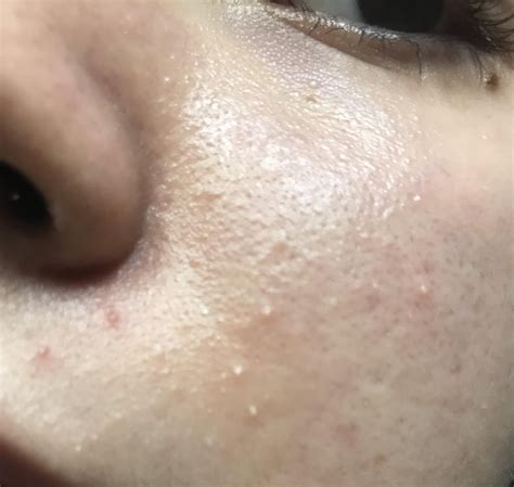 Small Bumps On My Face Routine Help Rskincareaddiction