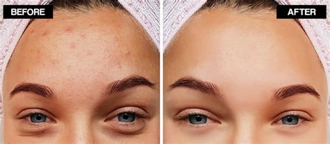 Forehead Acne Heres How To Treat At Home