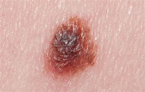 Can a Melanoma Biopsy Spread Bad Cells? — Scary Symptoms
