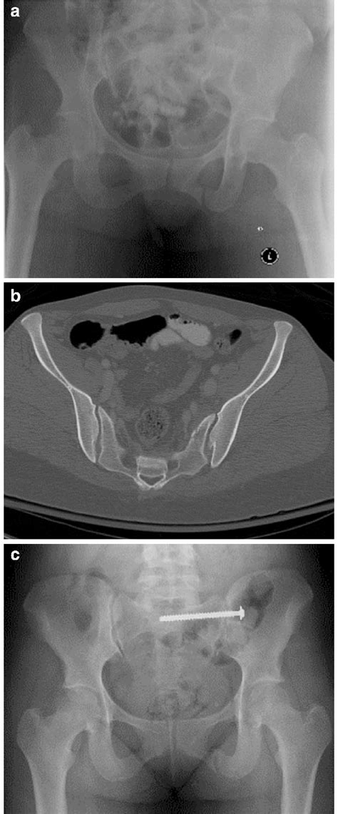 pelvic radiograph and ct scan of a 32 year old female who sustained a download scientific